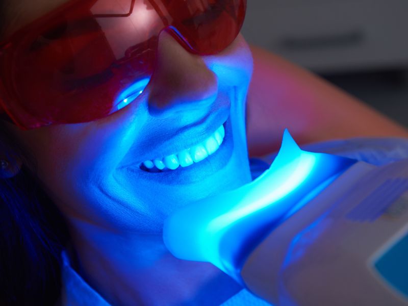 ¿Cuánto dura un blanqueamiento dental? Mitos y recomendaciones
