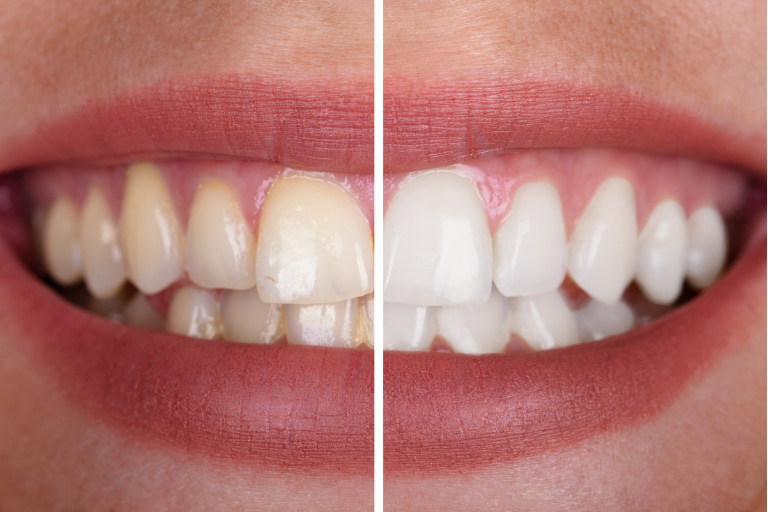 blanqueamiento dientes barcelona