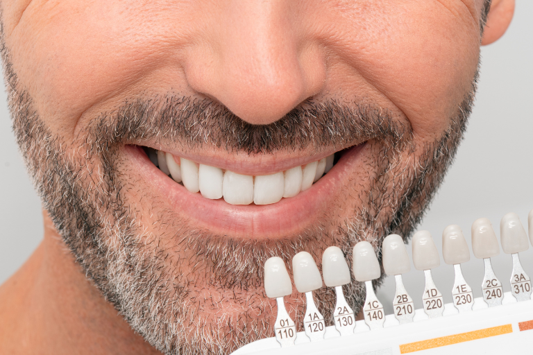 blanqueamiento en barcelona