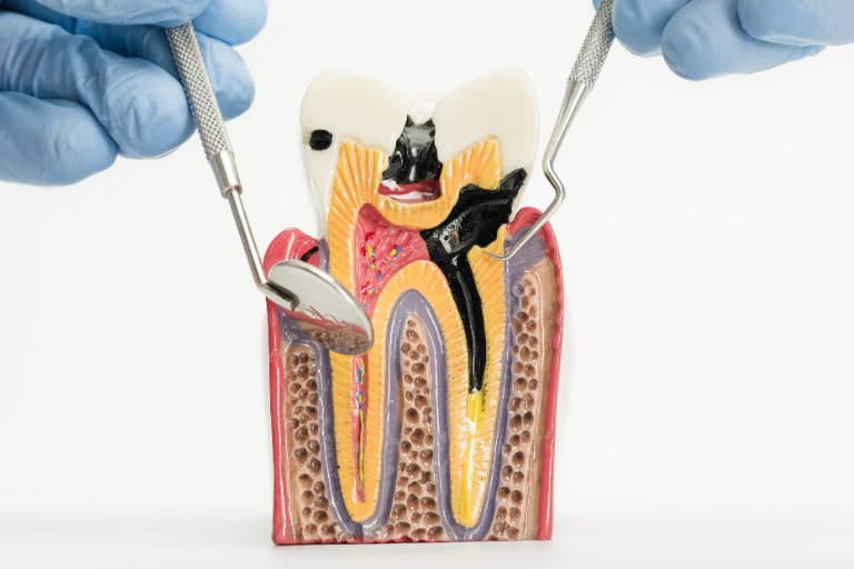 endodoncia en barcelona