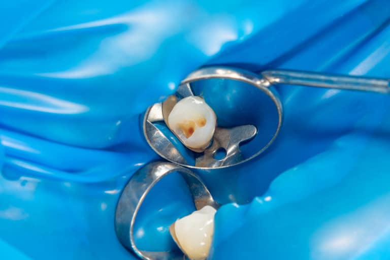 endodoncia en málaga