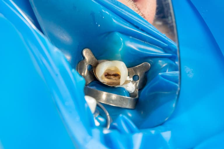 endodoncia dental barcelona
