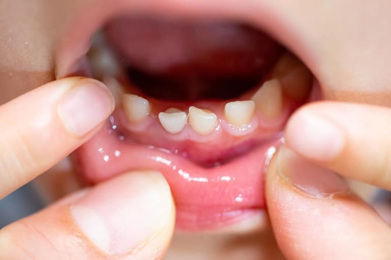 periodoncia infantil barcelona